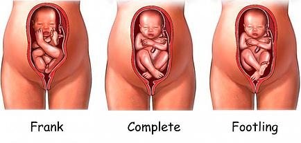 Baby in the frank breech position with their bottom on the cervix; a baby in the complete breech position with their bottom and both feet on the cervix; a baby in the footling breech position with one of their feet on the cervix.