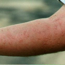Arm with fire ant stings after 5 minutes